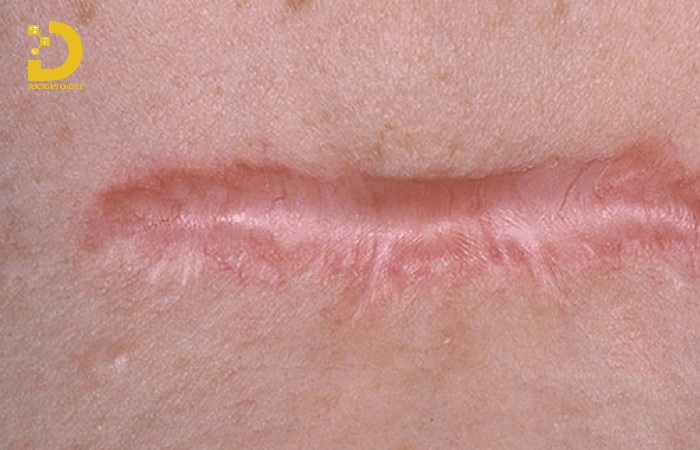 Hình ảnh sẹo lồi