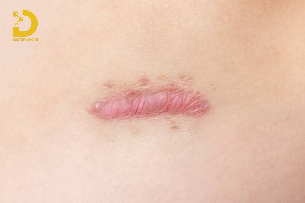 Hình ảnh sẹo phì đại