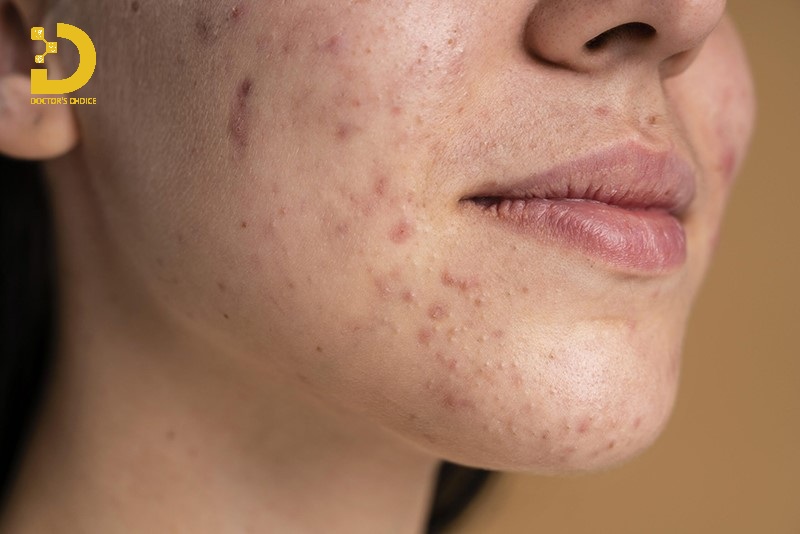 Hình ảnh sẹo thâm