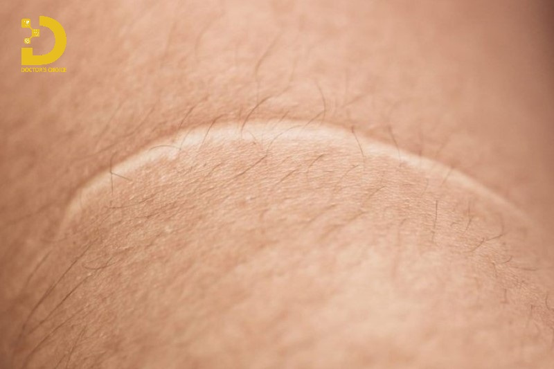 Hình ảnh sẹo trắng