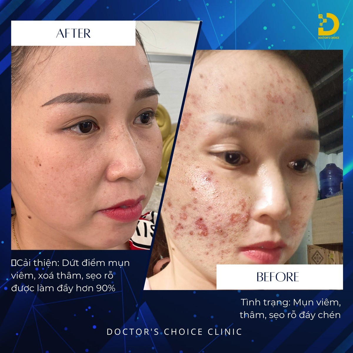 Hình ảnh điều trị mụn tại Dr Choice Clinic