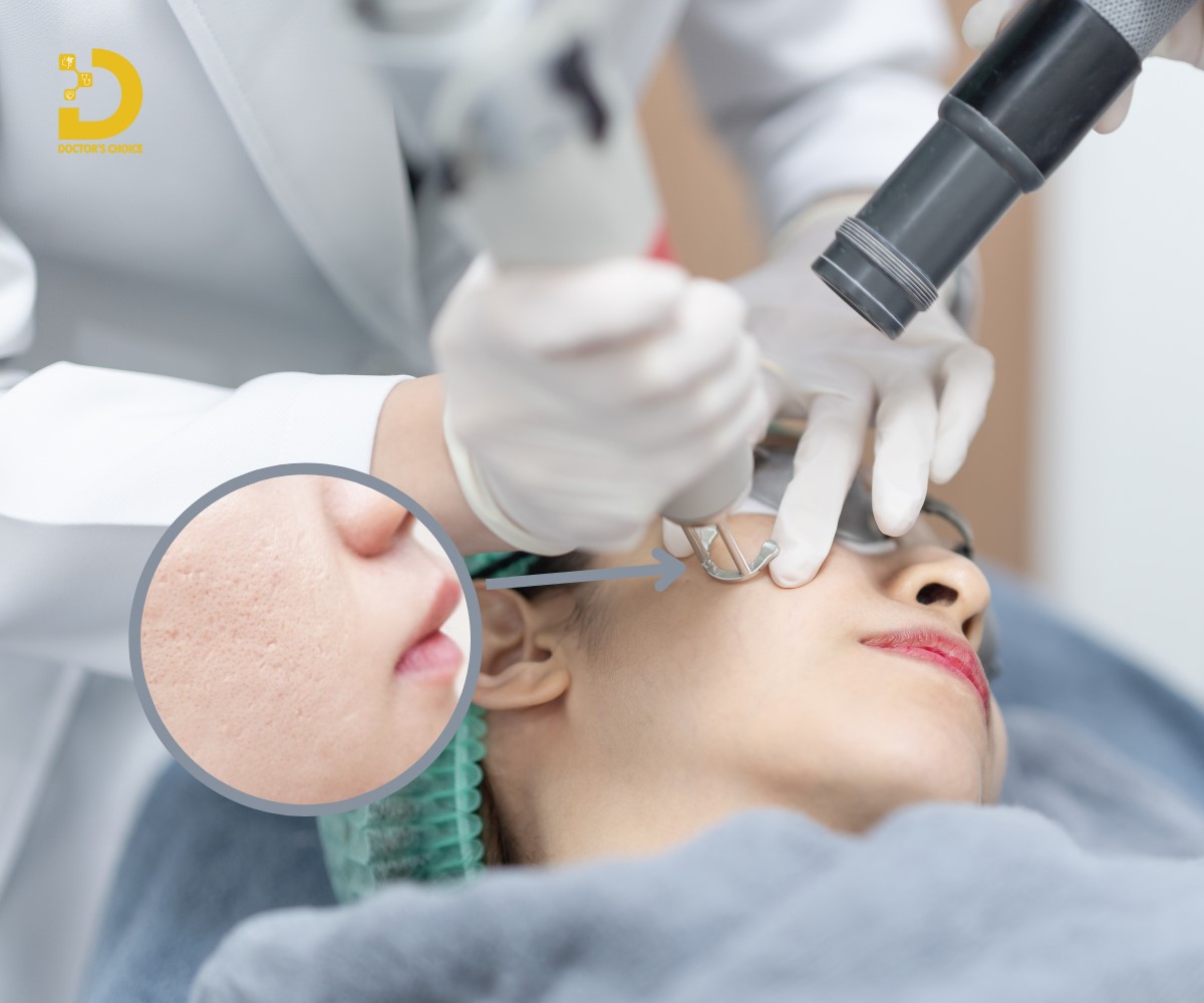 Phương pháp điều trị sẹo bằng laser