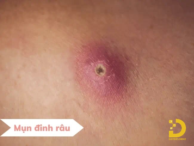 Hình ảnh mụn đầu đinh (mụn đinh râu)