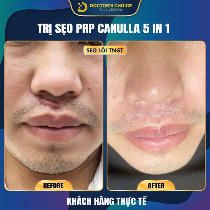 Hình ảnh thực tế trị sẹo bằng công nghệ PRP CANULLA 5 IN 1