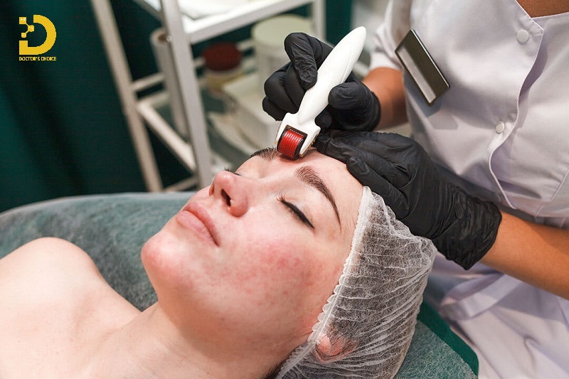 Điều trị sẹo giãn bằng lăn kim