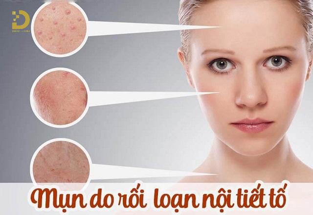 Mụn Ẩn Là Gì? Cách Phòng Ngừa Và Điều Trị Hiệu Quả Nhất 9 mun an 2