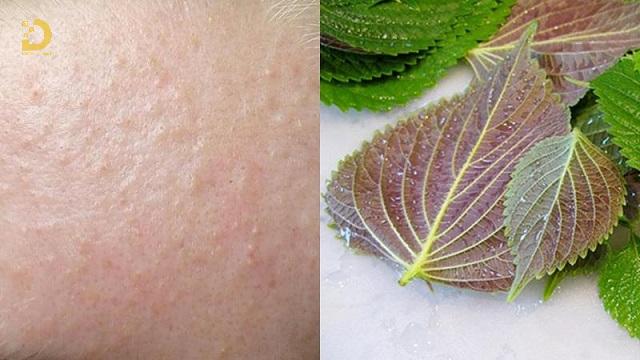 Mụn Ẩn Là Gì? Cách Phòng Ngừa Và Điều Trị Hiệu Quả Nhất 11 mun an 4