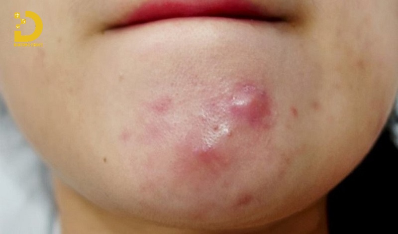 Hình ảnh mụn bọc