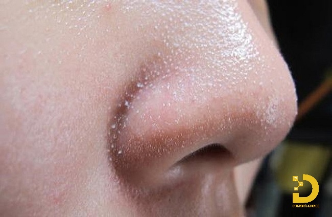 Hình ảnh mụn cám