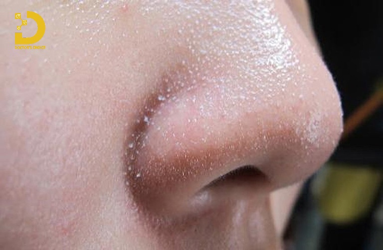 Hình ảnh mụn cám