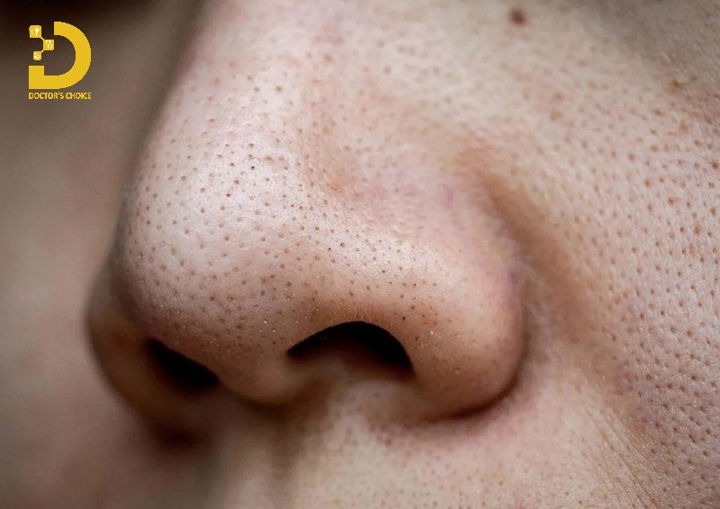 Hình ảnh mụn đầu đen