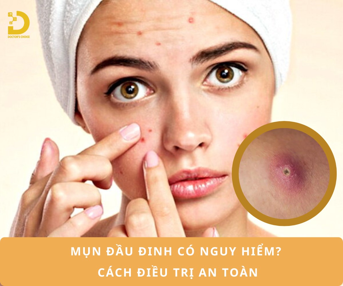 Tìm hiểu về mụn đầu đinh và cách điều trị