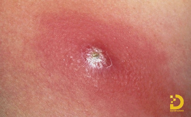 Mụn đầu đinh có thể gây biến chứng nếu không được điều trị đúng cách.