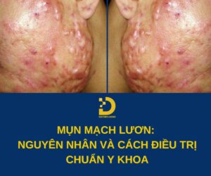 Tìm hiểu về mụn mạch lươn và cách điều trị hiệu quả, an toàn