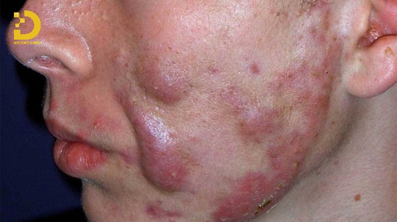 Hình ảnh mụn mạch lươn