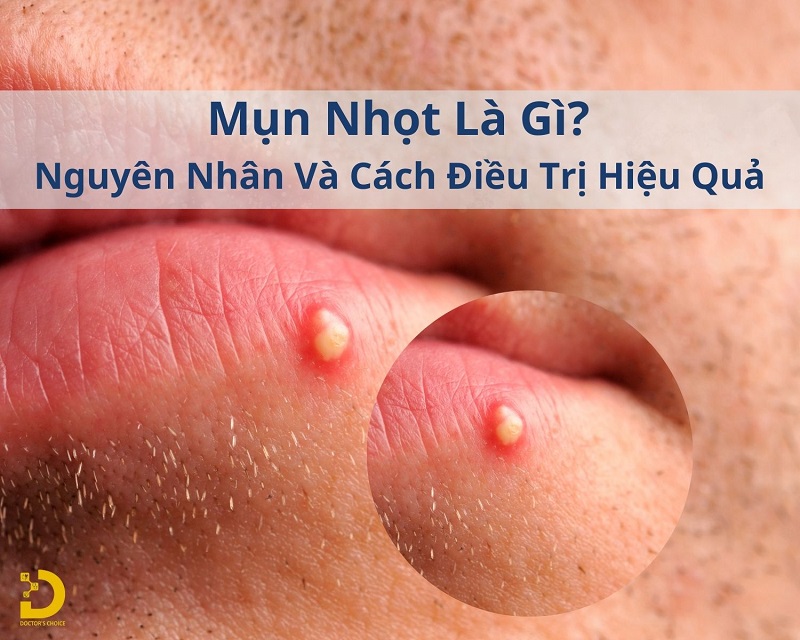 mụn nhọt là gì