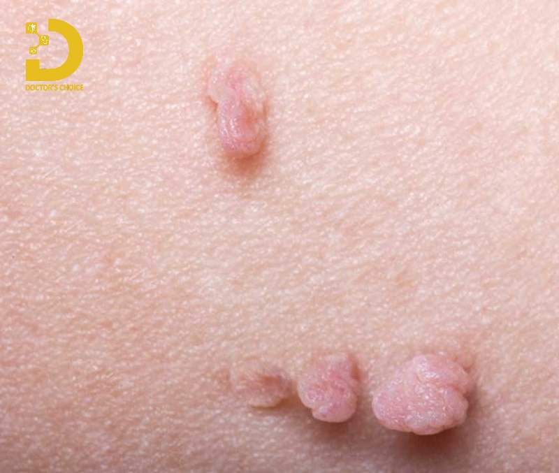 Hình ảnh mụn thịt