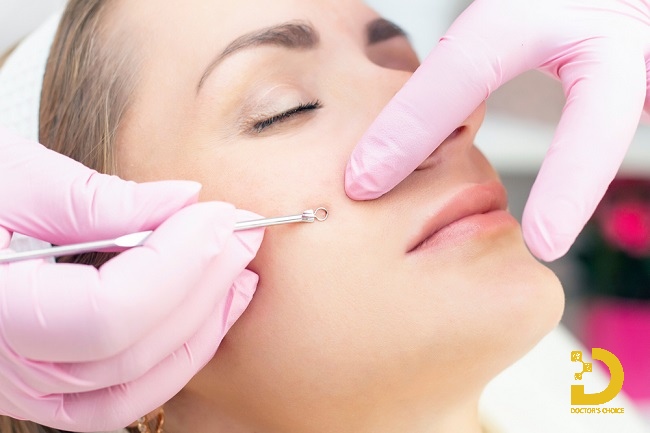 Quy trình nặn mụn cám chuẩn spa