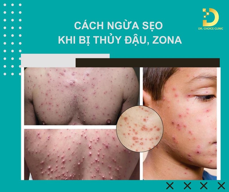 Cách ngừa sẹo khi bị thủy đậu/ zona