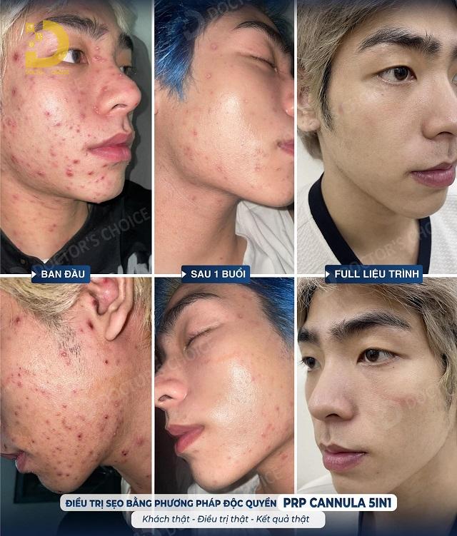 ngua seo thuy dau zona 3