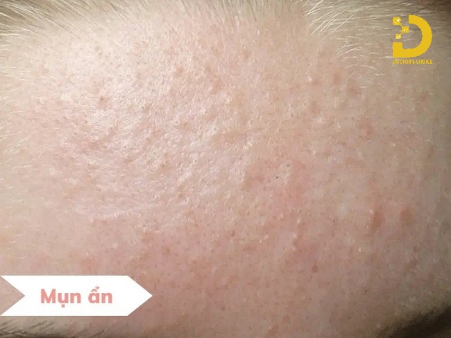 Nguyên nhân hình thàn mụn ẩn