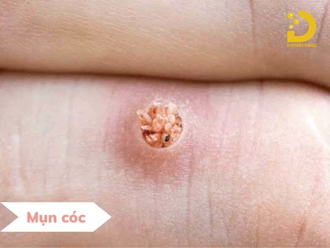 Nguyên nhân gây ra mụn cóc