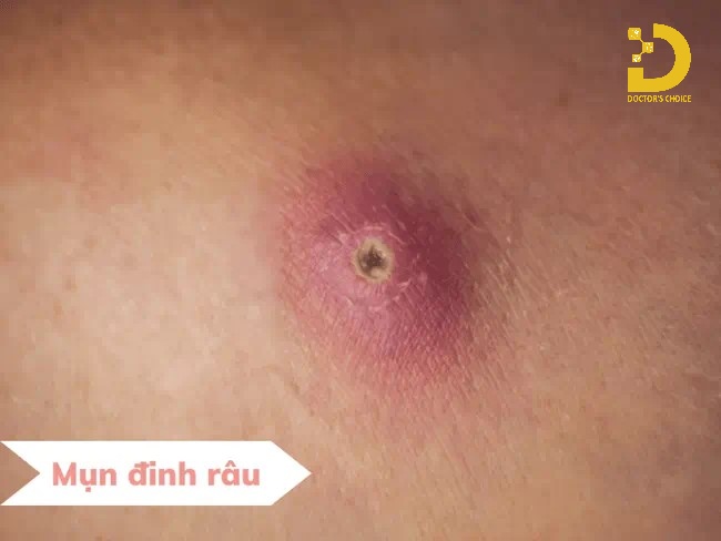 Nguyên nhân gây ra mụn đinh râu (mụn đầu đinh)