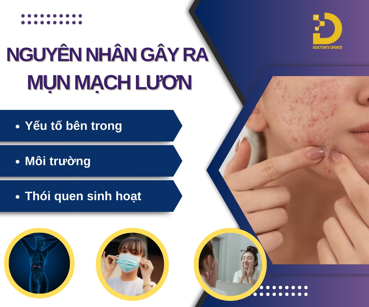 Nguyên nhân gây ra mụn mạch lươn