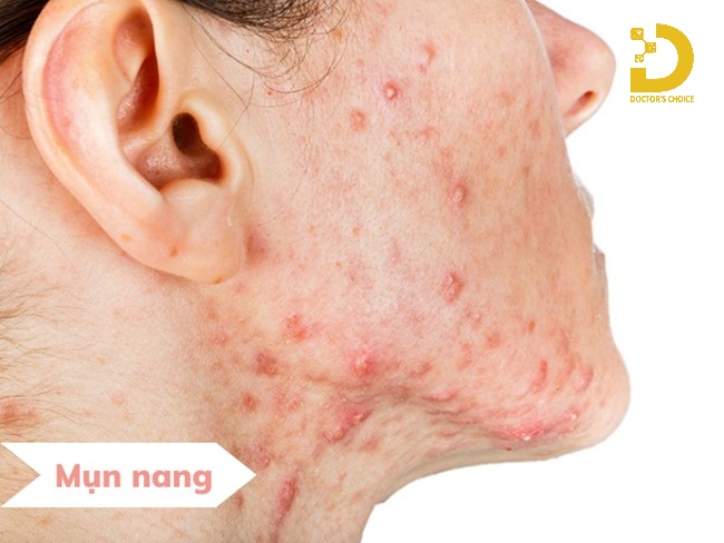 Nguyên nhân gây ra mụn nang