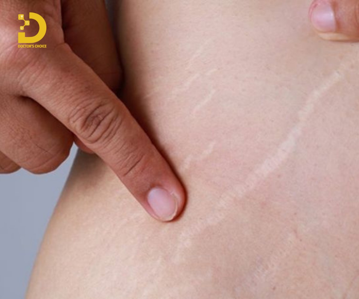 Seoh giãn do tăng cân nhanh, có thai, tuổi tác, di truyền, bệnh lý, dùng thuốc.