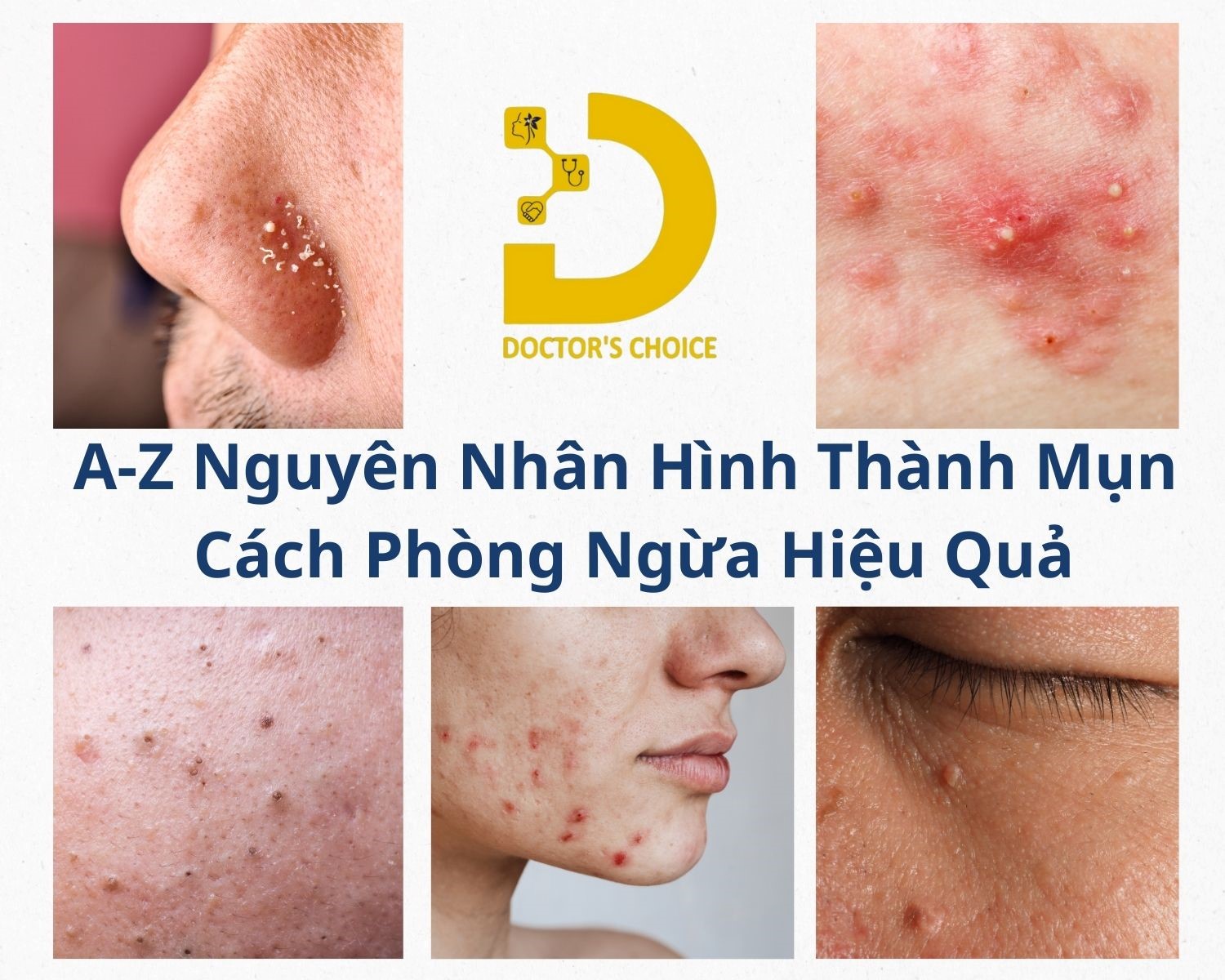Nguyên nhân hình thành các loại mụn
