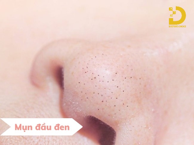 Nguyên nhân hình thành mụn đầu đen