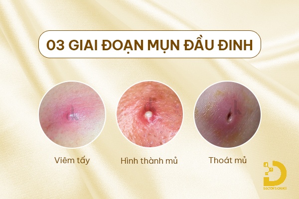 Các giai đoạn hình thành mụn đầu đinh