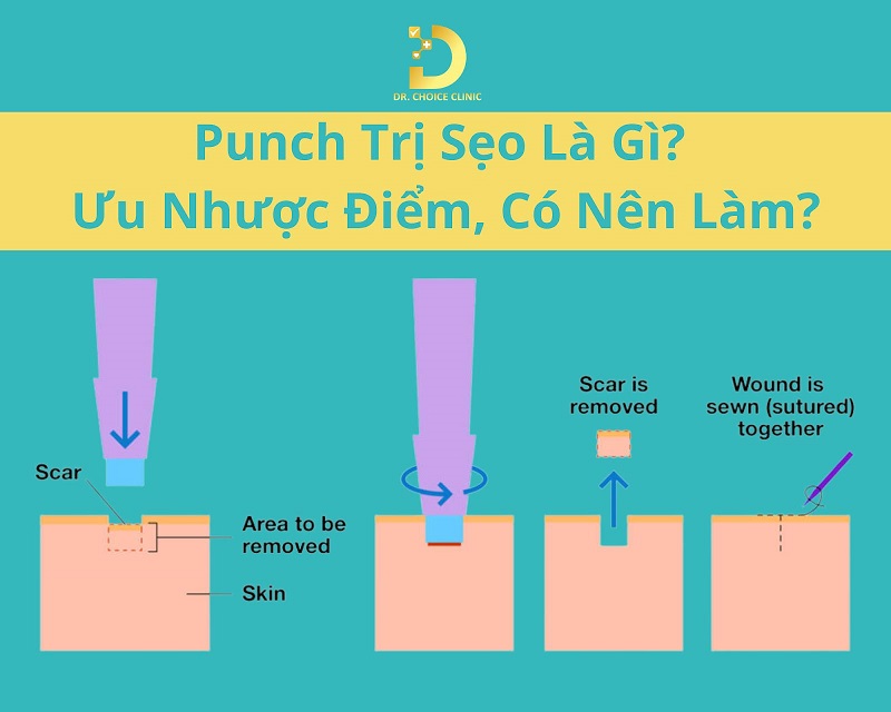 Punch trị seo là gì
