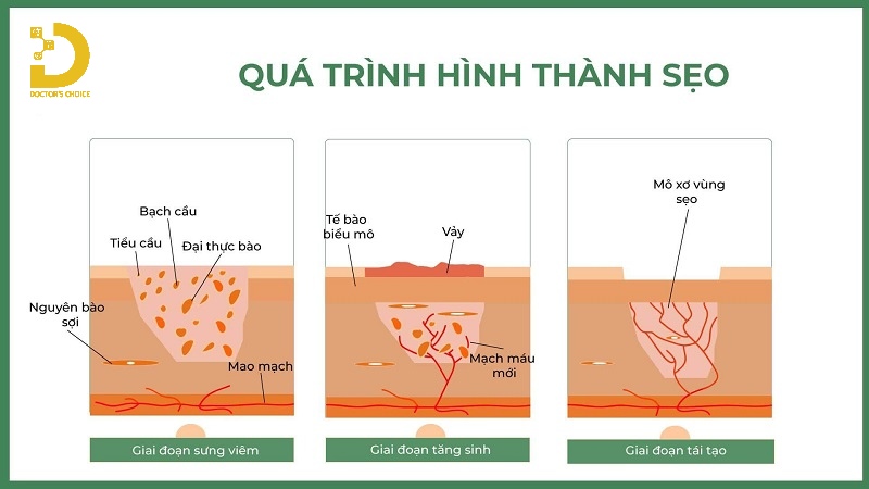 Quá trình hình thành sẹo phì đại