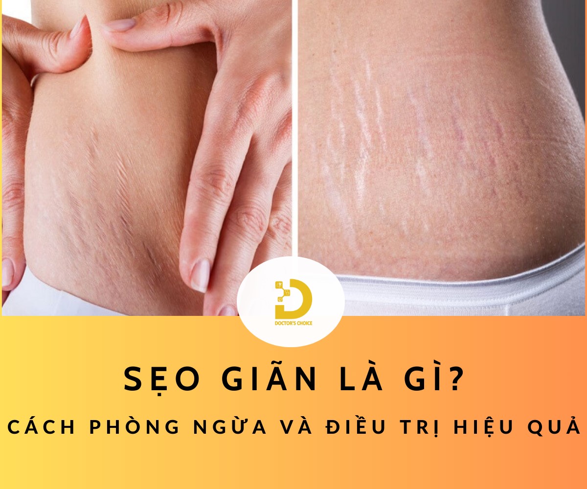 Tìm hiểu về sẹo giãn và cách điều trị