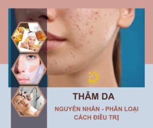 Thâm da: Nguyên nhân, phân loại & cách điều trị hiệu quả