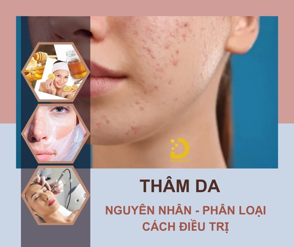 Tình trạng thâm da và cách điều trị