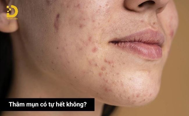 Thời gian để cơ thể tự mờ thâm mụn có thể kéo dài từ vài tuần đến vài tháng, thậm chí lâu hơn.