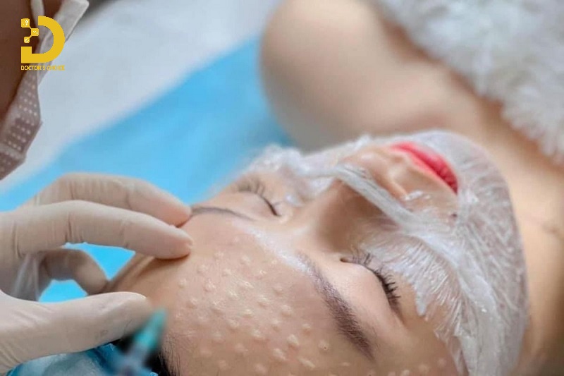 Tiêm Mesotherapy trị mụn