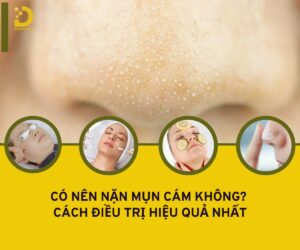 Tìm hiểu về mụn cám và cách điều trị hiệu quả