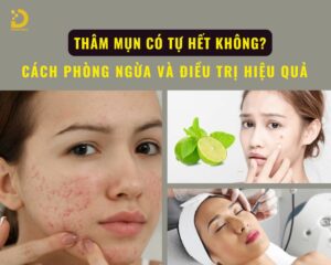 Tìm hiểu về thâm mụn và cách điều trị