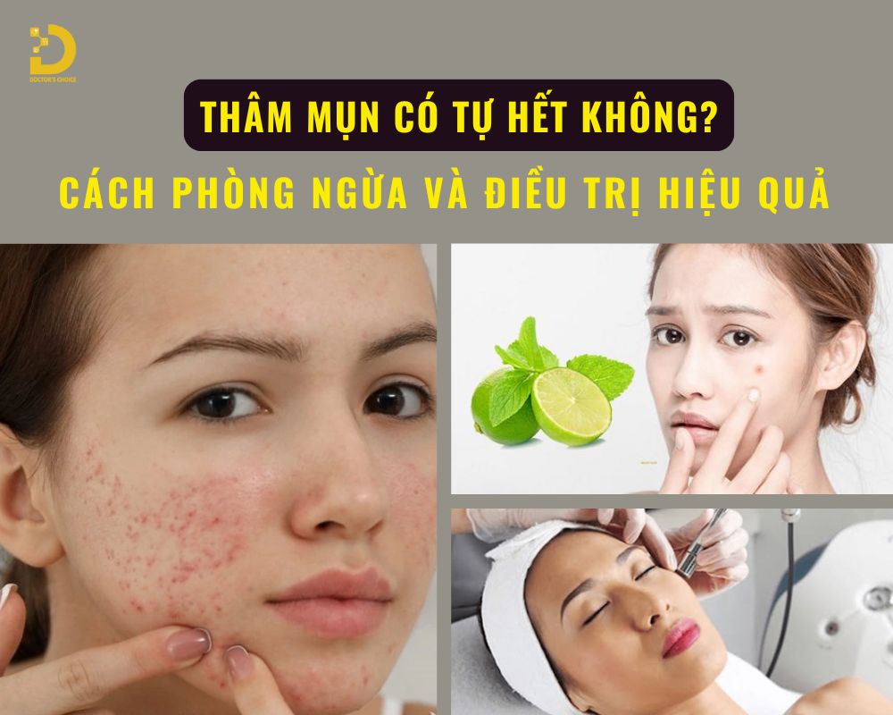 Tìm hiểu về thâm mụn và cách điều trị