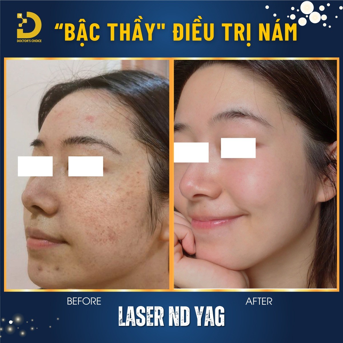 Trẻ Hóa Da Bằng Laser: Ưu Nhược Điểm, Công Nghệ Nào Tốt? 10 tre hoa da bang cong nghe laser 3