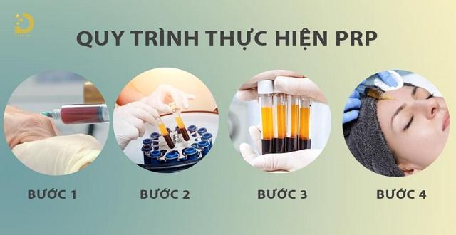 Trẻ Hóa Da Bằng PRP Là Gì? Ưu Nhược Điểm, Có Nên Làm? 11 tre hoa da bang prp 2