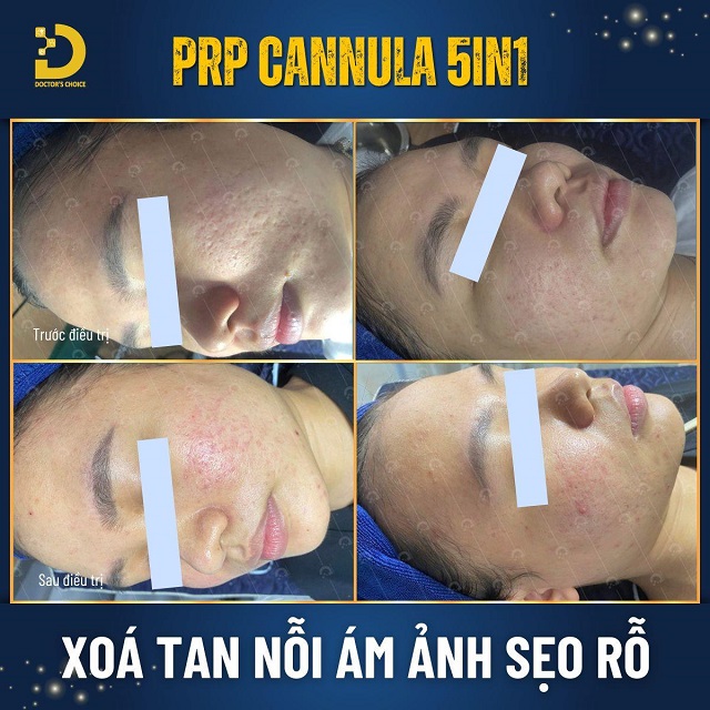 tre hoa da bang prp 6