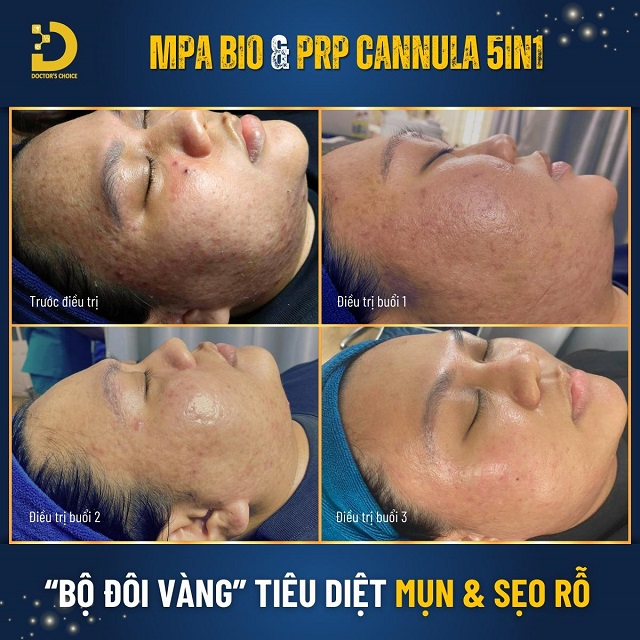 tre hoa da bang prp 7