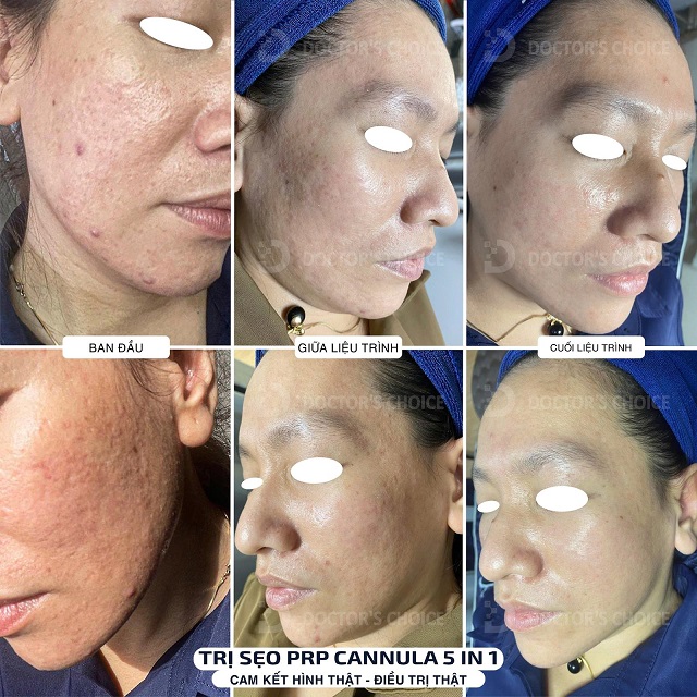 Trẻ Hóa Da Bằng PRP Là Gì? Ưu Nhược Điểm, Có Nên Làm? 17 tre hoa da bang prp 8