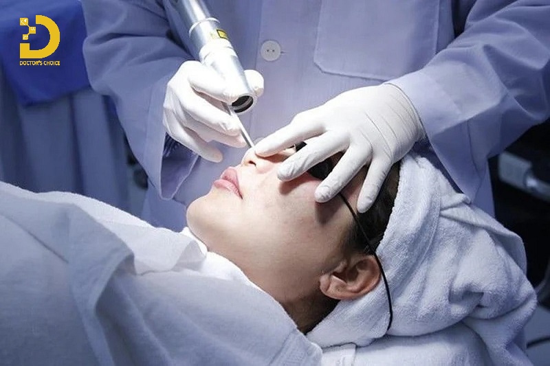 Trị mụn đầu đen bằng laser