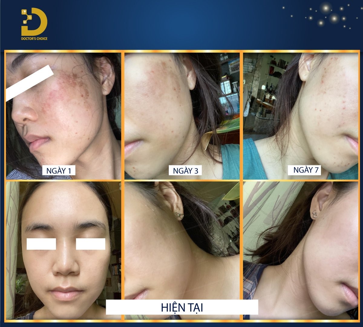 Kết quả điều trị nám bằng laser (ảnh 2)